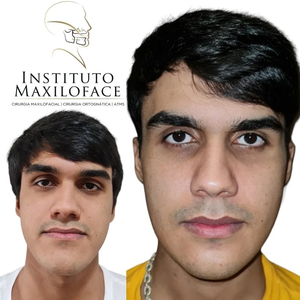 Cirurgia Ortognática - Instituto Maxilo Facial